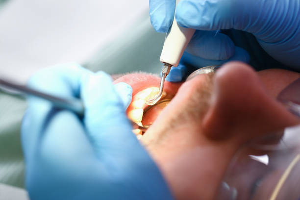 Best Emergency Wisdom Teeth Removal in Tarboro, NC