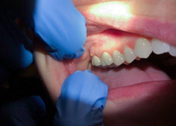 Best Emergency Denture Repair in Tarboro, NC